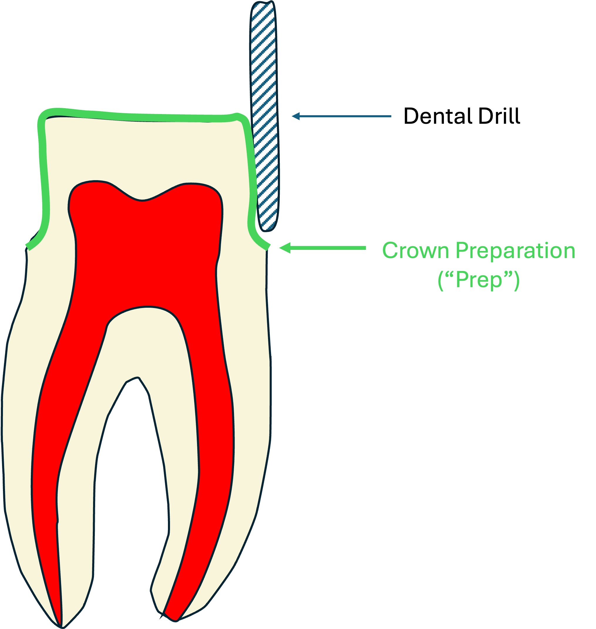 What is a “crown” and how is it different than a “cap”? – Mouthing Off
